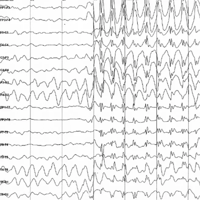 Effect of acute stress on dynamic decision making